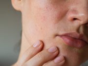 Peau granuleuse visage : comment retrouver une peau lisse ? peau granuleuse visage