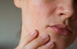 Peau granuleuse visage : comment retrouver une peau lisse ? peau granuleuse visage