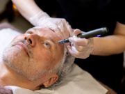 Les Avis Négatifs sur le Microneedling : Risques, Complications et Précautions Essentielles Avis Négatifs sur le Microneedling