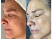 Tarifs du Jet Peel : Investissement beauté Tarifs du Jet Peel