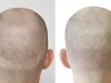 Micropigmentation des cheveux : Le guide ultime pour une chevelure de rêve Micropigmentation des cheveux