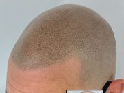 Dermopigmentation : Comment Ça Marche et Pour Qui Est-ce Idéal ? Dermopigmentation