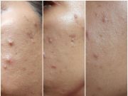 Avant et Après : Les Effets de l’Acide Glycolique sur Votre Peau Avant et Après - Les Effets de l'Acide Glycolique