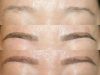 Détatouage Sourcil : Techniques, Coûts et Témoignages Détatouage Sourcil