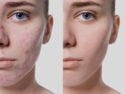 Dermaroller visage avant après : résultats réels et conseils dermaroller avant après