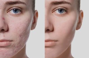 Dermaroller visage avant après : résultats réels et conseils dermaroller avant après