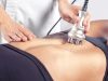 Lipocavitation : Efficacité, Témoignages et Précautions avis sur lipocavitation