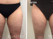 Cryolipolyse cuisses avant après : découvrez les résultats sans chirurgie Cryolipolyse cuisses avant après