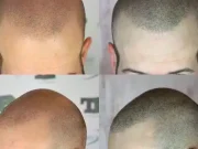 Tricopigmentation : prix, douleur, résultats Tricopigmentation