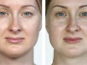 Avant/après mésothérapie visage : effet coup d’éclat ou déception ? Avant après mésothérapie visage