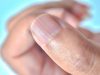 Ongles striés : est-ce un indicateur d’un trouble du foie ? Ongles striés foie