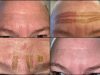 Plasma Lift : tout savoir sur cette technique innovante pour rajeunir la peau Plasma Lift
