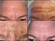 Plasma Lift : Tout savoir sur le lifting sans chirurgie (guide) Plasma Lift