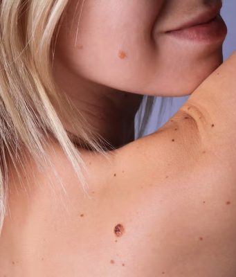 Grain de beauté qui gratte : faut-il s’inquiéter ? Grain de beauté qui gratte