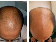 Laduti pour la repousse des cheveux : est-ce vraiment efficace ? laduti avis