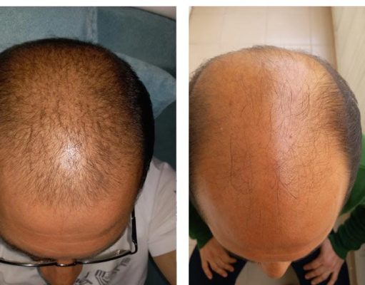 Laduti pour la repousse des cheveux : est-ce vraiment efficace ? laduti avis