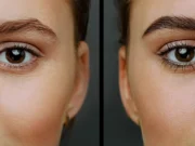 Brow lift : photos avant/après bluffantes brow-lift-avant-apres