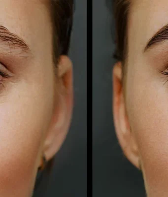 Brow lift : photos avant/après bluffantes brow-lift-avant-apres