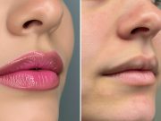 Candy Lips avant/après : la vraie transformation candy-lips-avant-apres