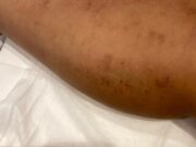Que faire en cas de brûlure après épilation laser du maillot brulure-epilation-laser-maillot