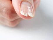 Ongle fendu verticalement : que faire pour le réparer vite ? ongle-fendu-verticalement-que-faire