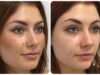 Injection joue avant/après : le secret d’un visage rajeuni sans chirurgie injection-joue-avant-apres