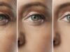 Microneedling avant/après 1 séance : résultats réels et attentes microneedling-avant-apres-1-seance