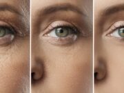 Microneedling avant/après 1 séance : résultats réels et attentes microneedling-avant-apres-1-seance