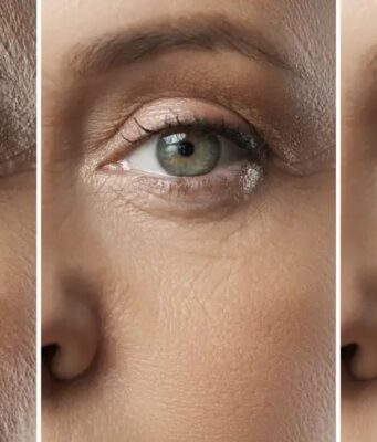 Microneedling avant/après 1 séance : résultats réels et attentes microneedling-avant-apres-1-seance