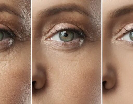 Microneedling avant/après 1 séance : résultats réels et attentes microneedling-avant-apres-1-seance