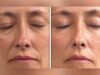 Lpg visage avis avant/après : résultats réels pour savoir à quoi vous attendre lpg-visage-avis-avant-apres