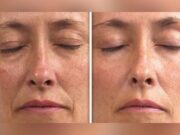 Lpg visage avis avant/après : résultats réels pour savoir à quoi vous attendre lpg-visage-avis-avant-apres