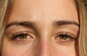 Paupière tombante : quelles solutions pour ouvrir et rajeunir le regard paupiere-tombante