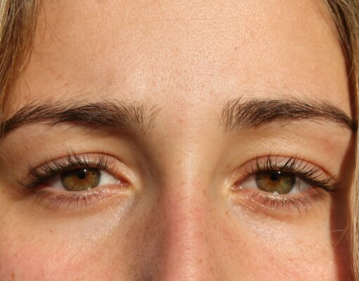 Paupière tombante : quelles solutions pour ouvrir et rajeunir le regard paupiere-tombante