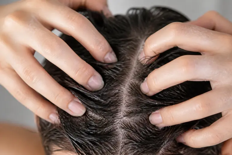 Mains massant délicatement le minoxidil mousse sur le cuir chevelu avec la pulpe des doigts